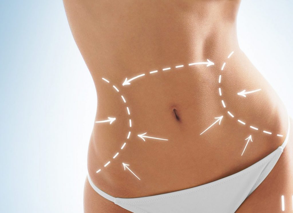 abdominoplastia