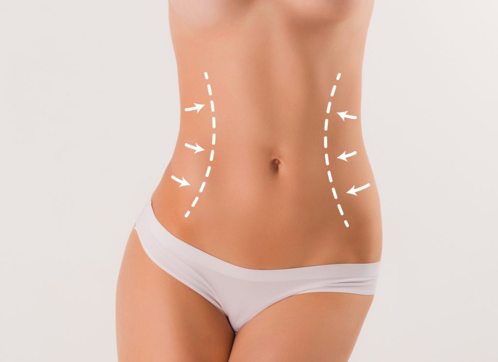 lipoescultura